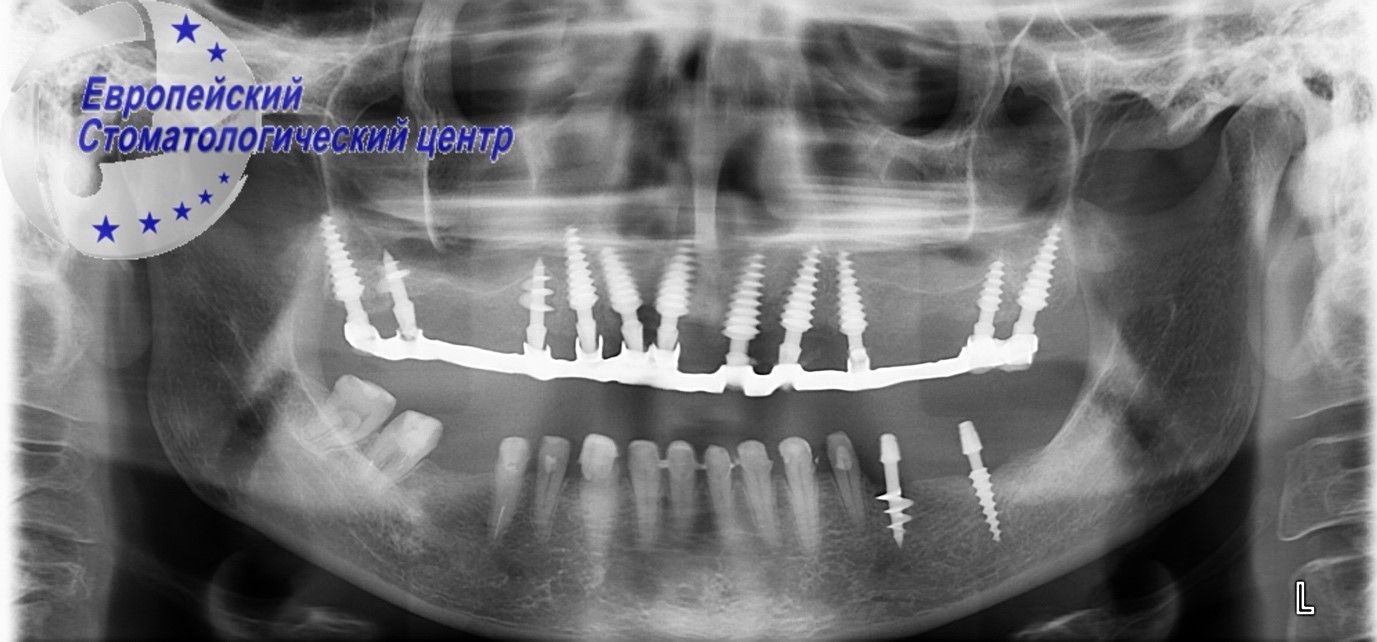 implantacija 11w