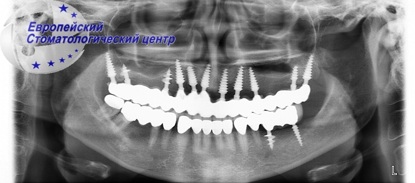 implantacija 13w