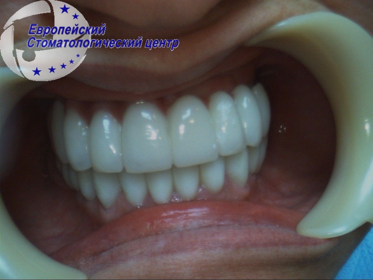 implantacija 14w