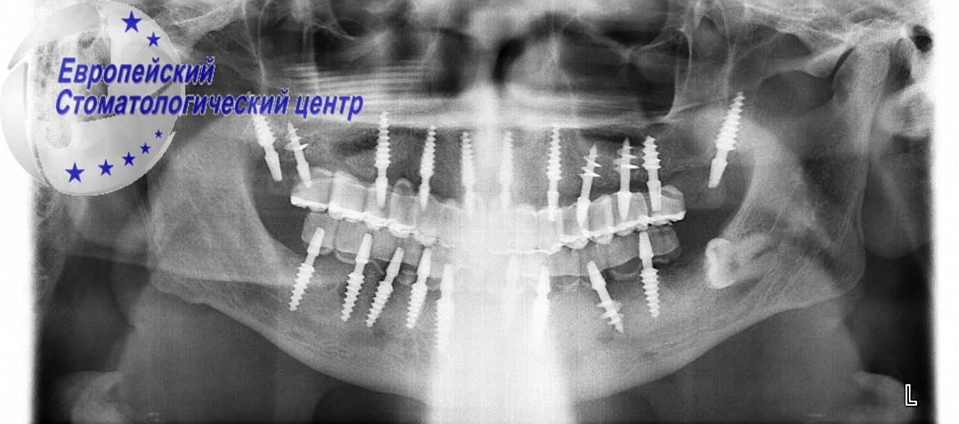 implantacija 15q