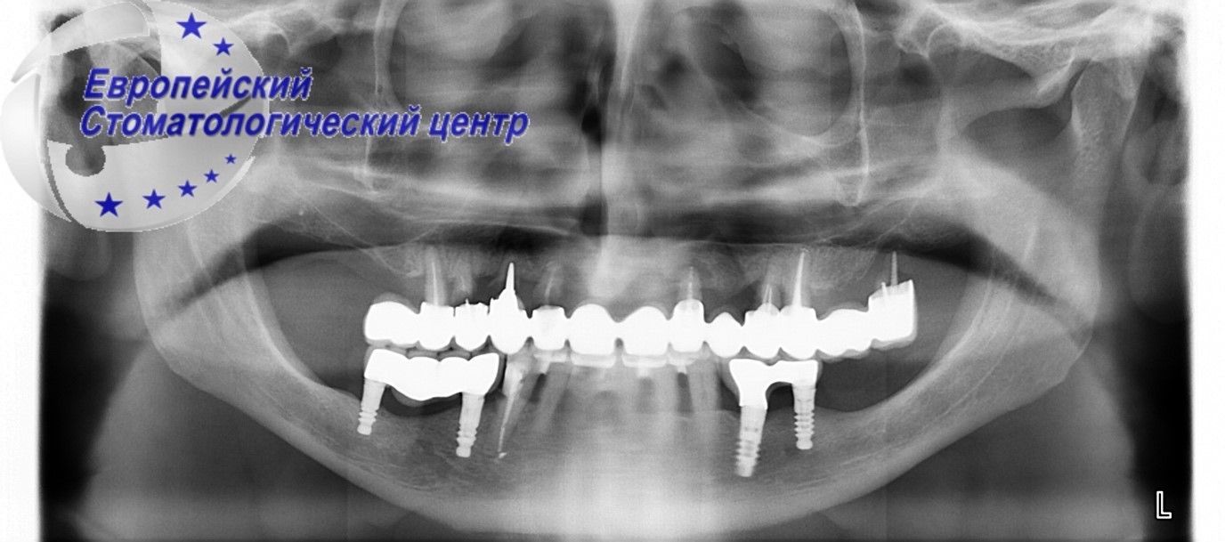 implantacija 15w