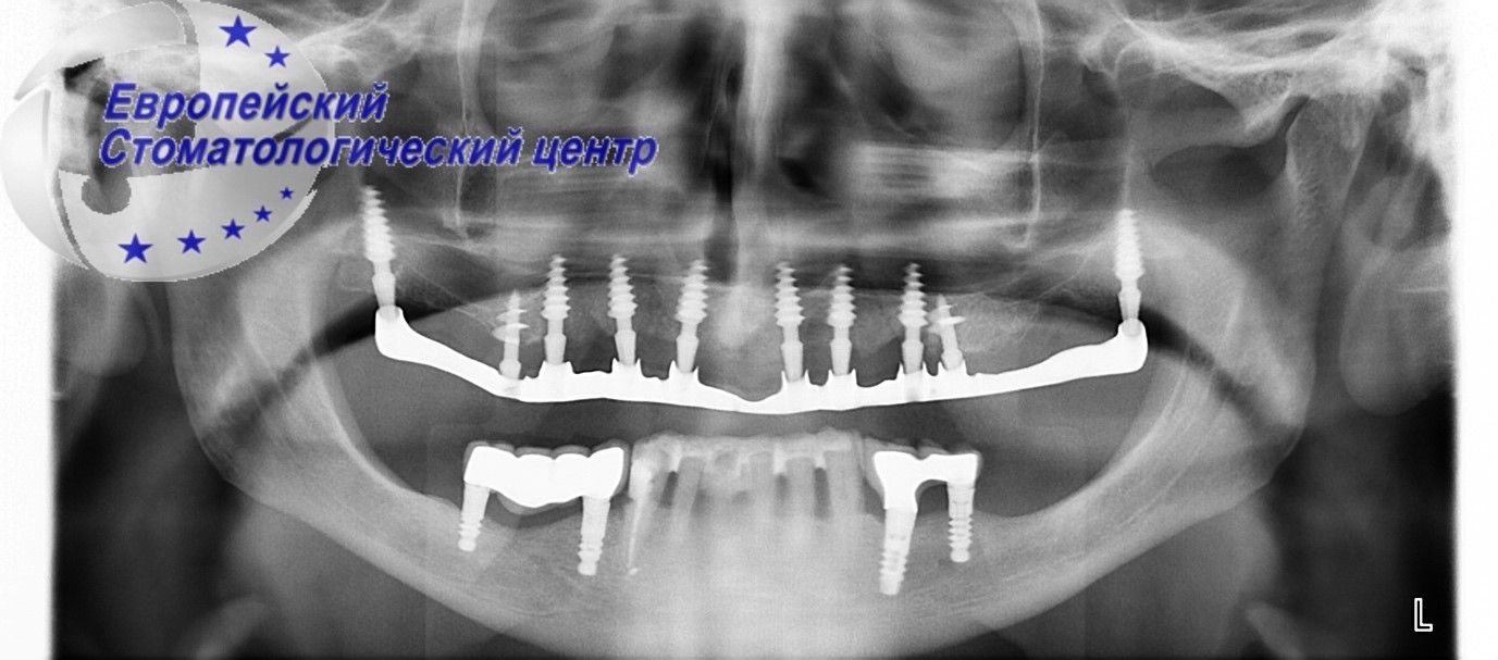 implantacija 16w