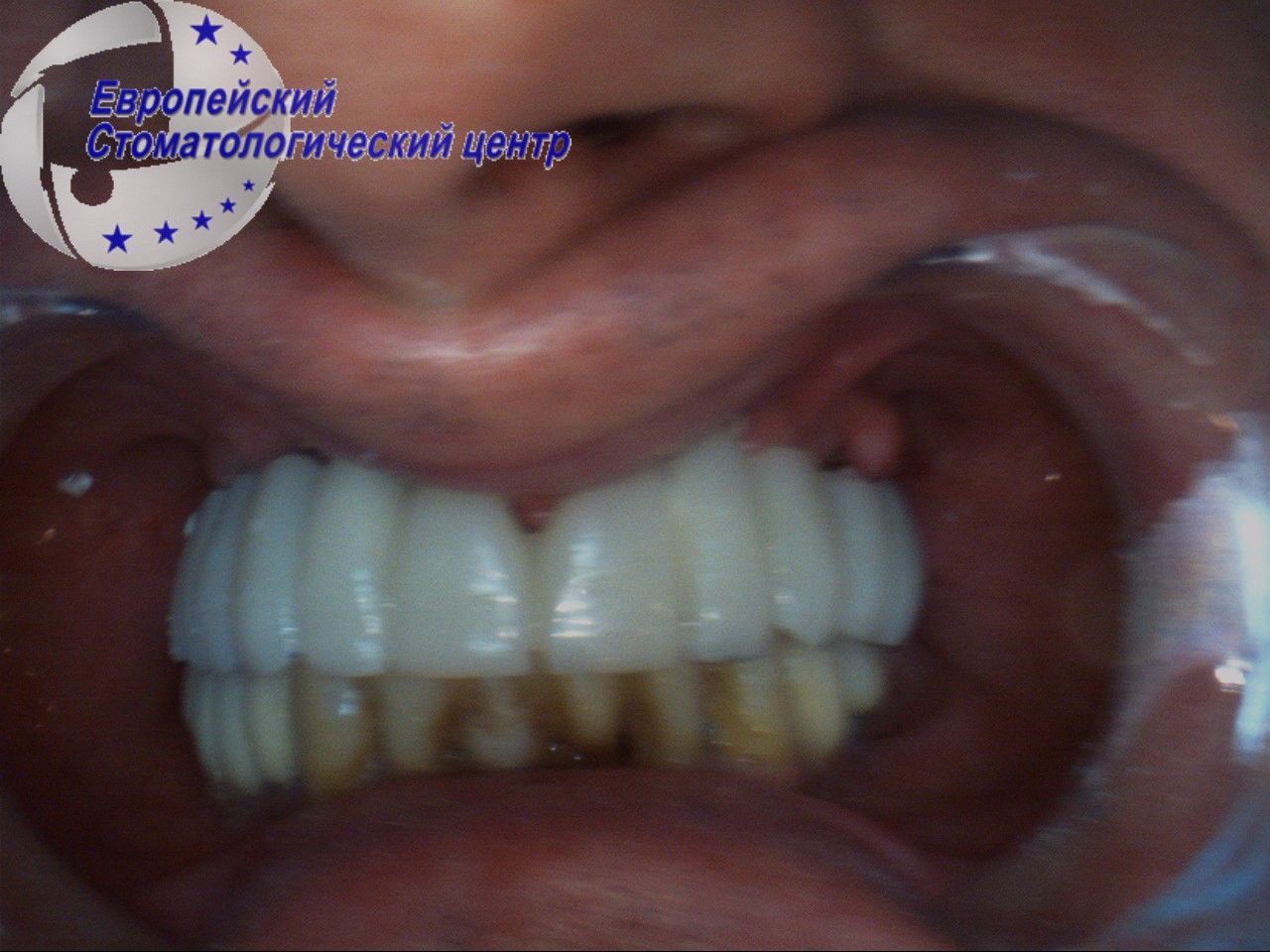 implantacija 17w