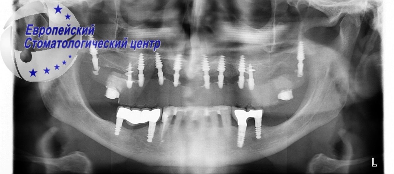 implantacija 18w