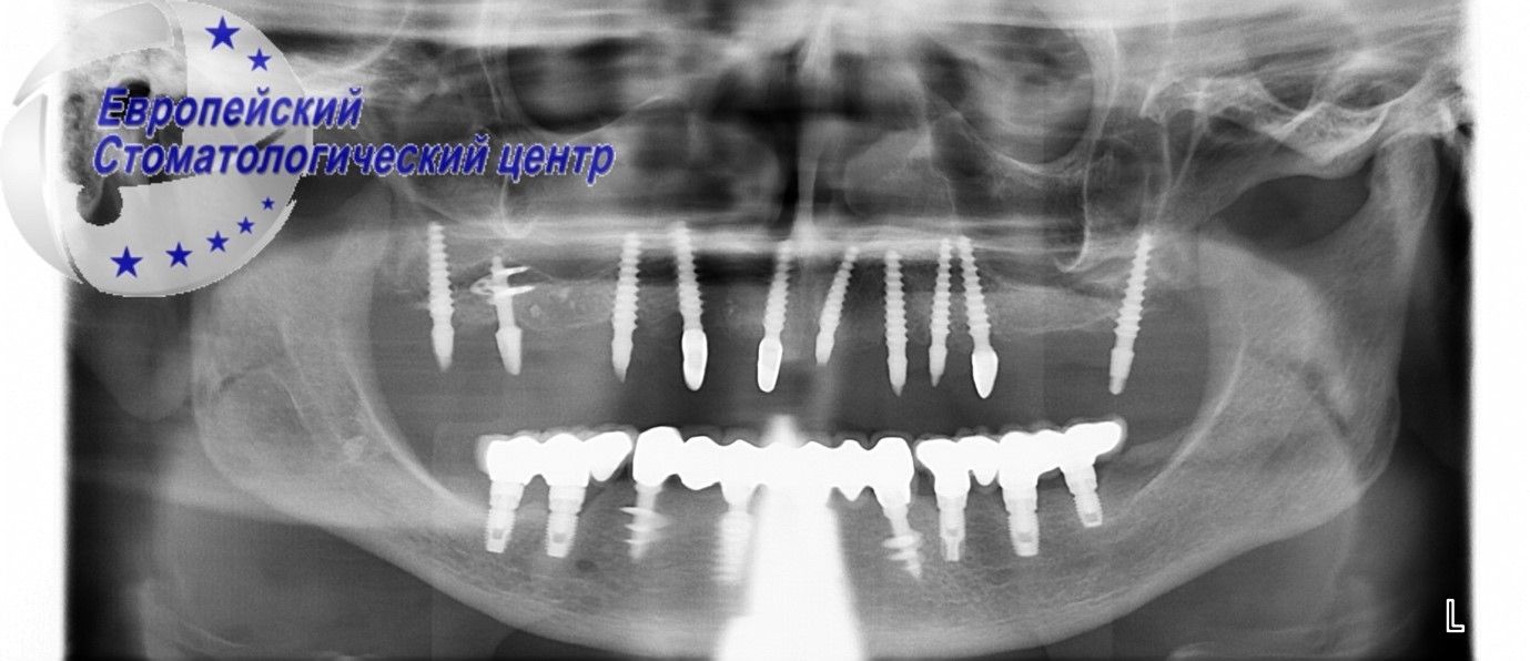 implantacija 1w