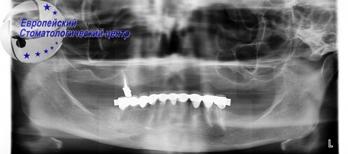 implantacija 22q