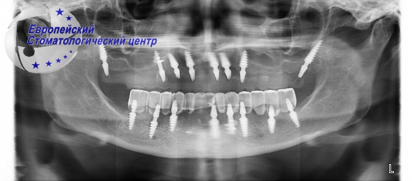 implantacija 23q