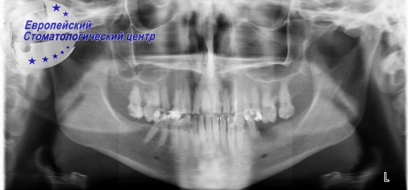 implantacija 23w