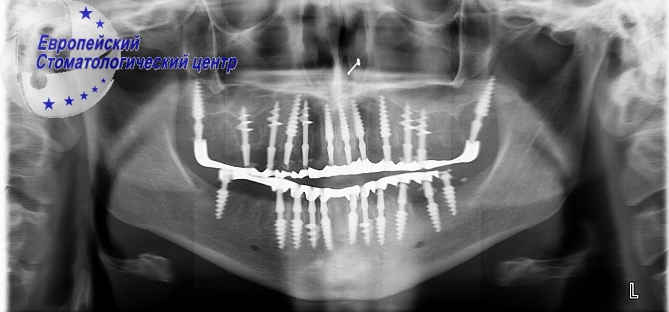 implantacija 24w