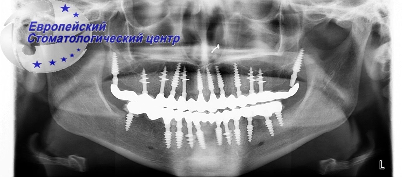 implantacija 27w