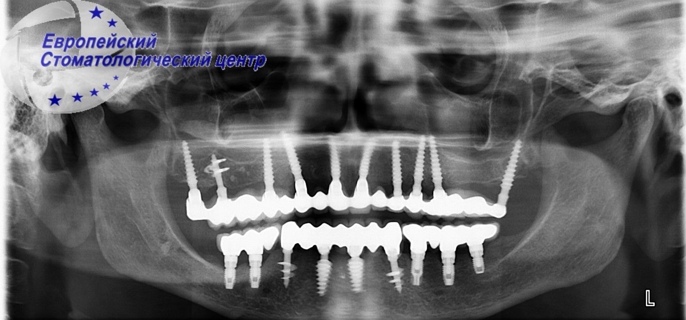 implantacija 2w