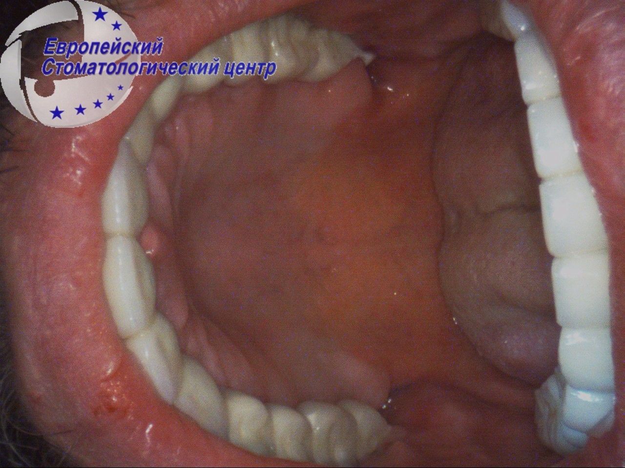 implantacija 31q