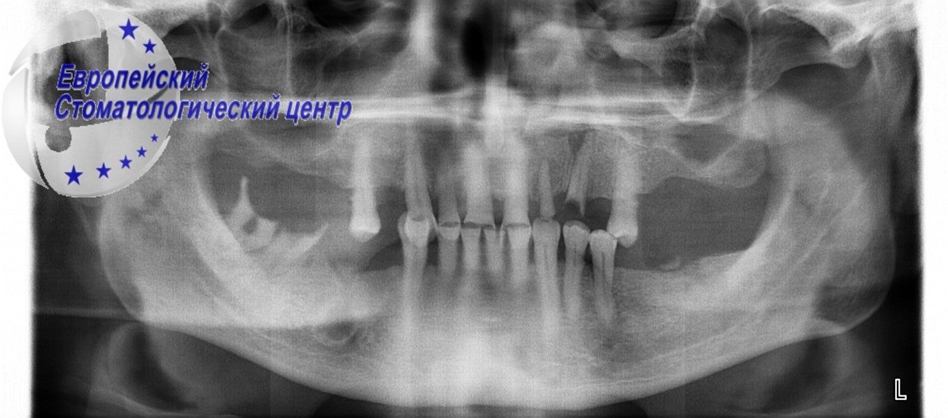 implantacija 33q