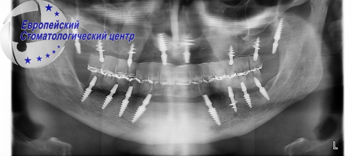 implantacija 41q