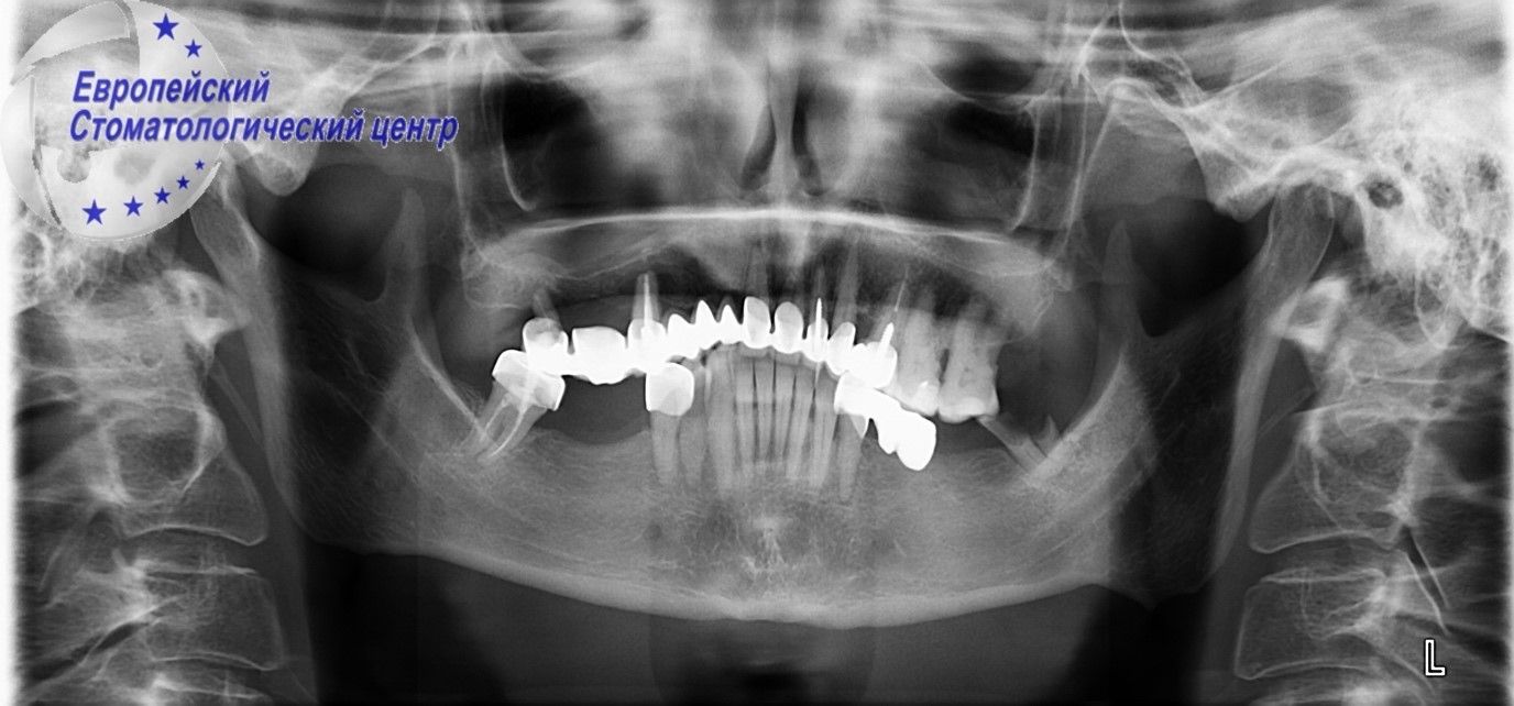 implantacija 4w