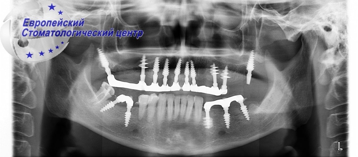 implantacija 5w