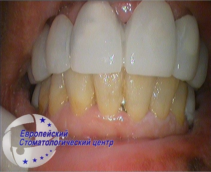 implantacija 6w