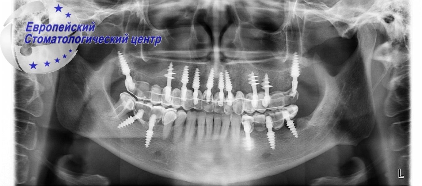 implantacija 8w