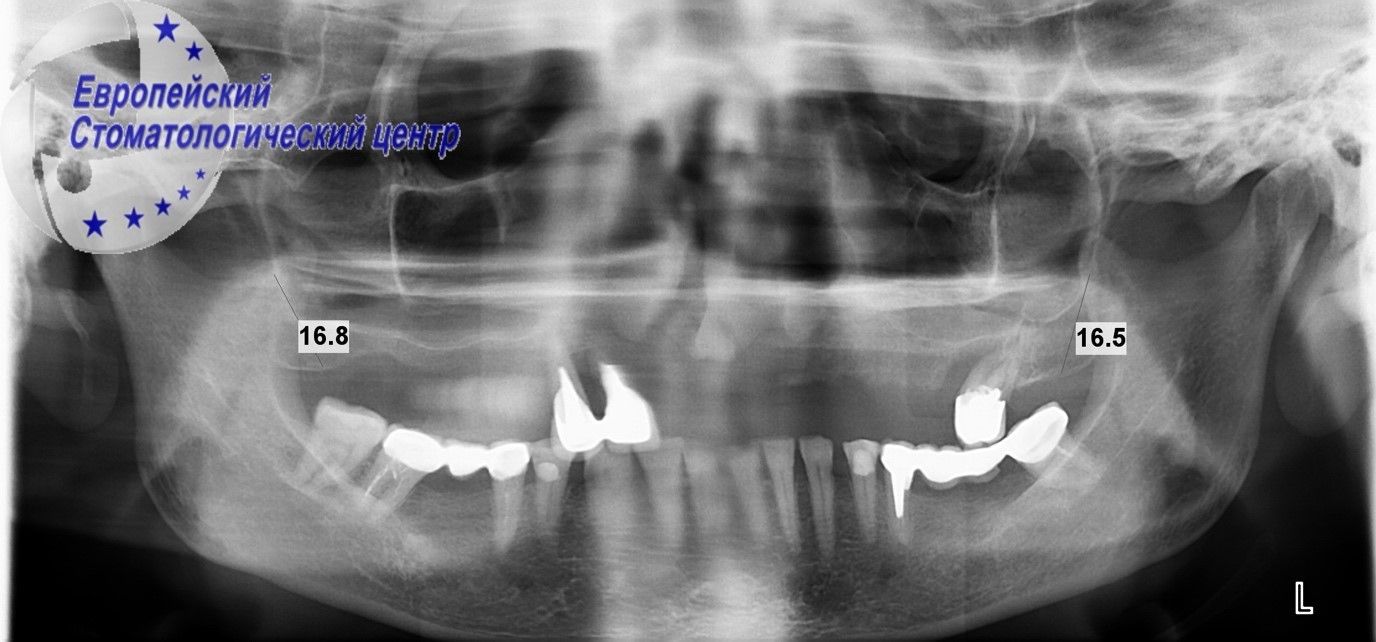 implantacija 9w