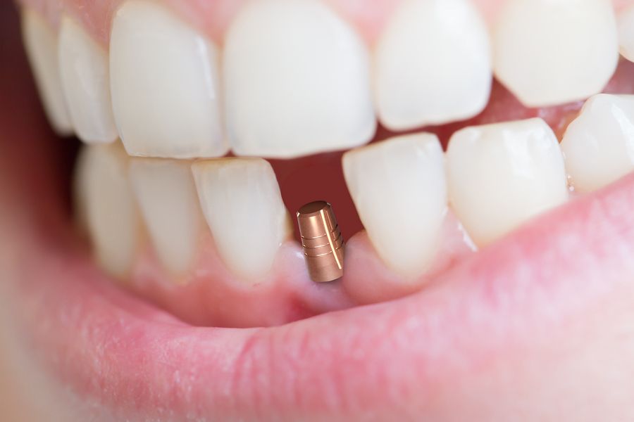 Отек после имплантации зуба - сколько держится, как снять