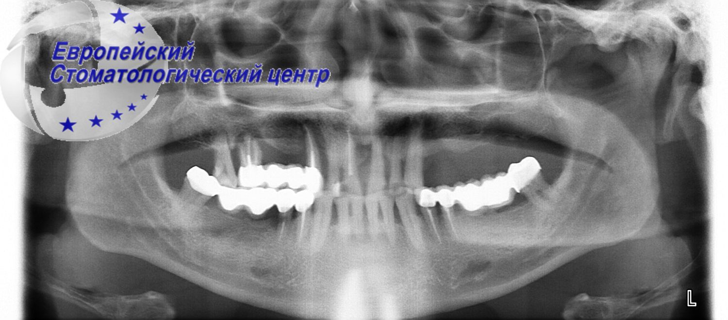 implantacija 11