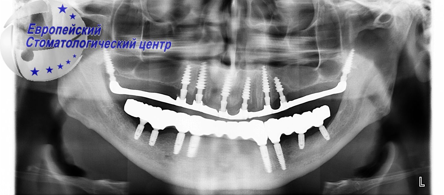 implantacija 1111