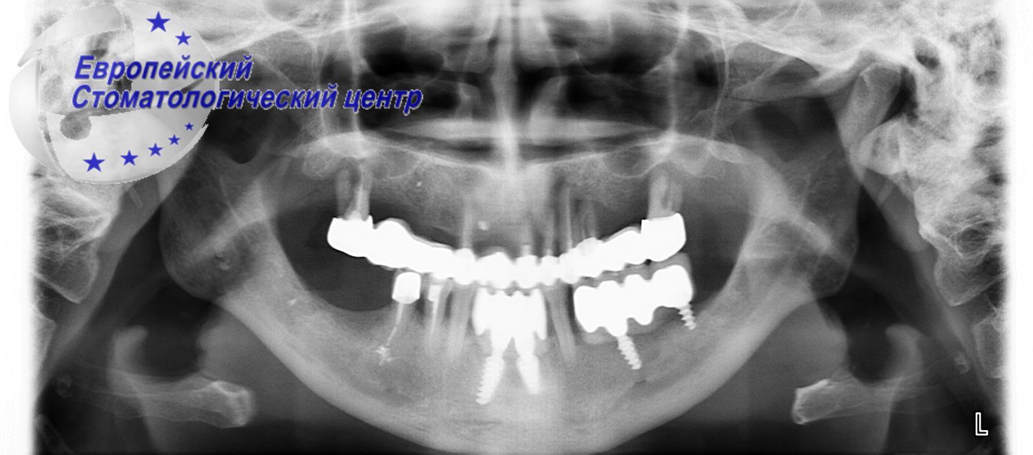 implantacija 1313