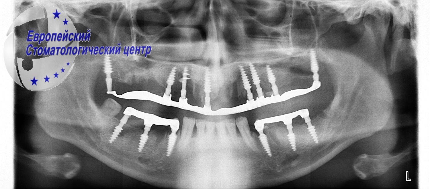 implantacija 33