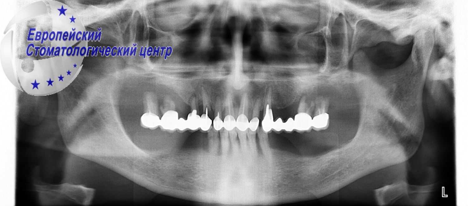 implantacija 55