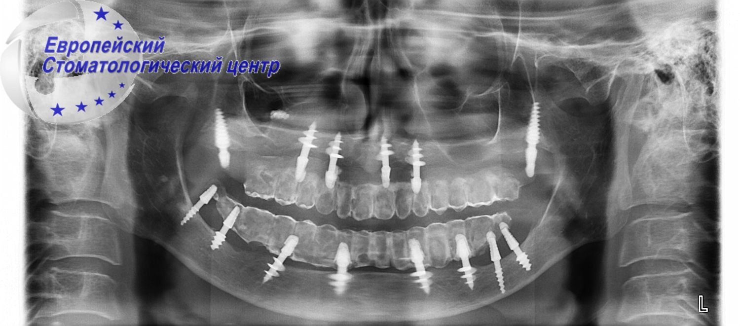 implantacija 11e