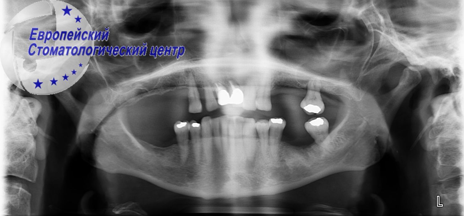 implantacija 13e