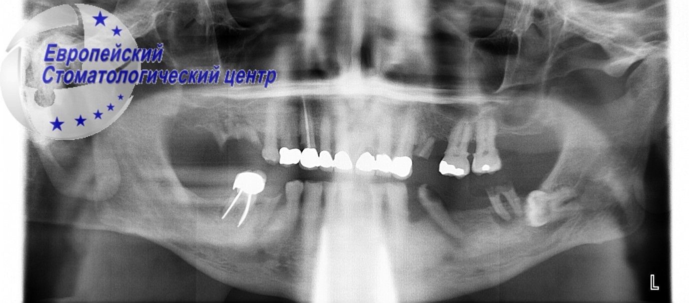 implantacija 14q