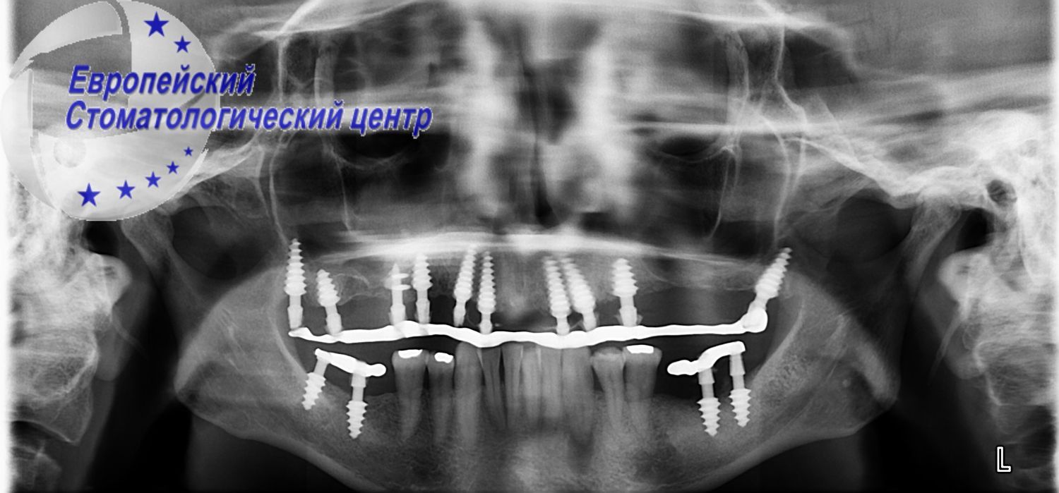 implantacija 19e