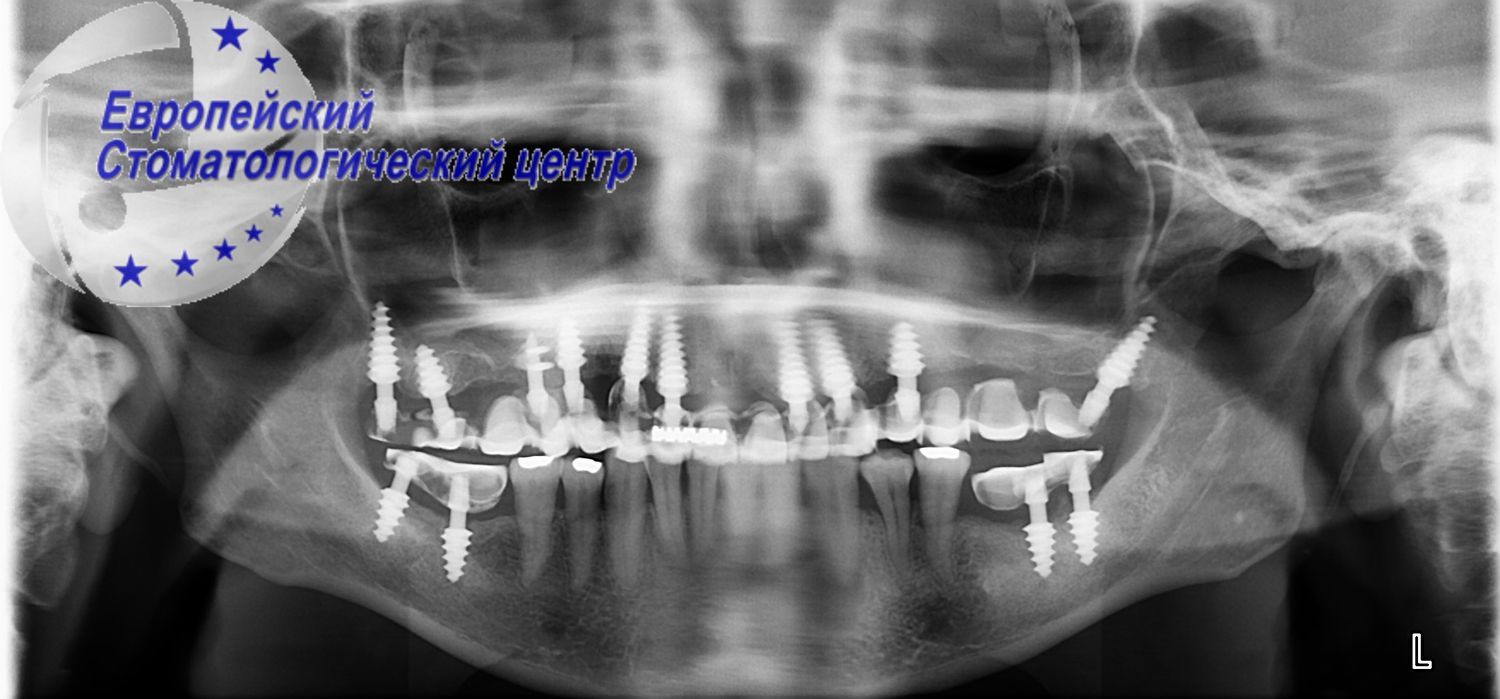 implantacija 21e