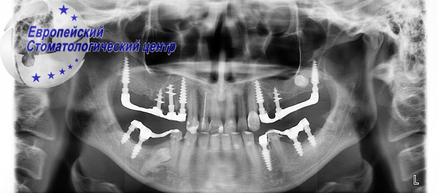 implantacija 26e