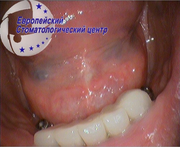 implantacija 2e