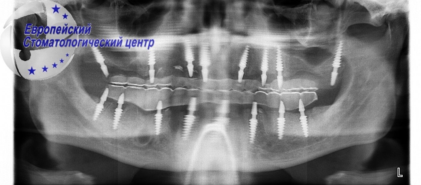 implantacija 34q