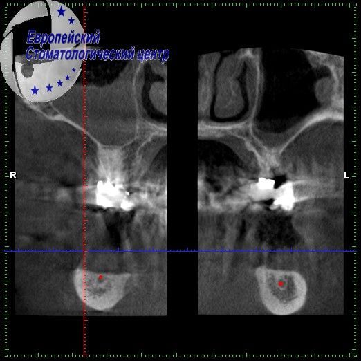 implantacija 3e