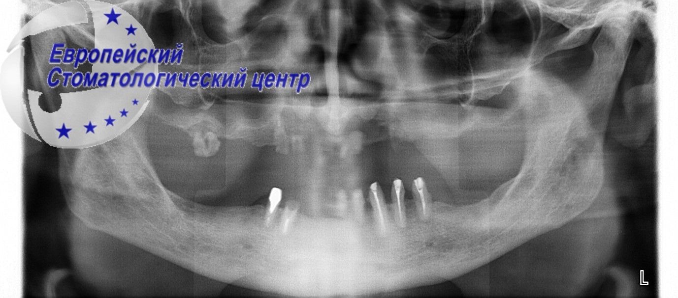 implantacija 40q