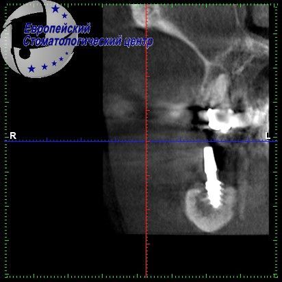 implantacija 4e