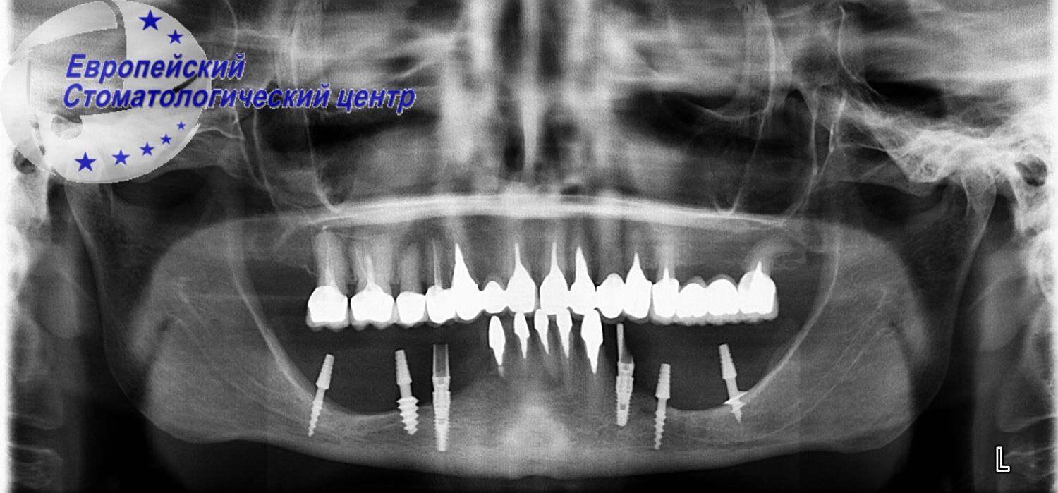 implantacija 5e