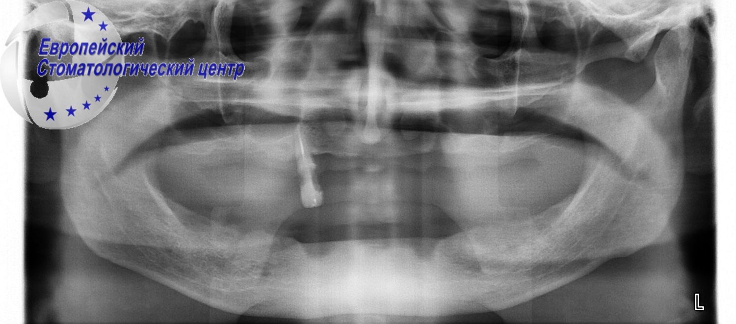 implantacija 6q