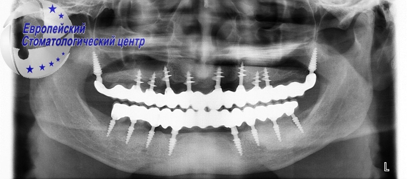 implantacija 7q