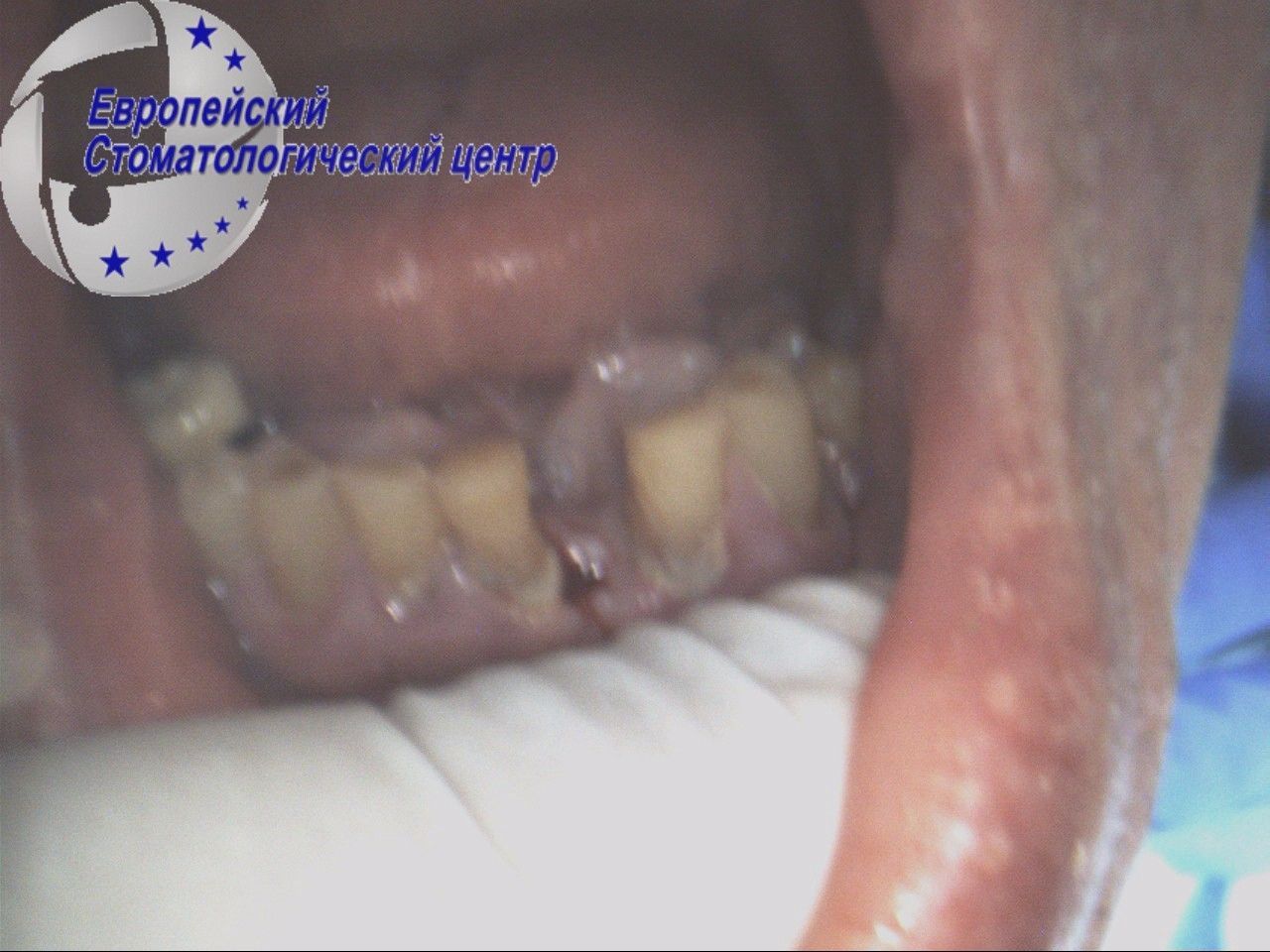 implantacija 8q