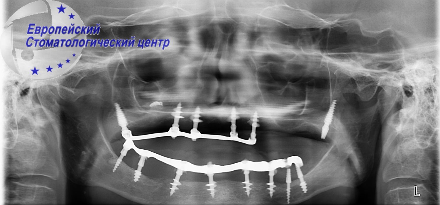 implantacija 9e